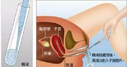 人工授精视频,科技助力生育新篇章