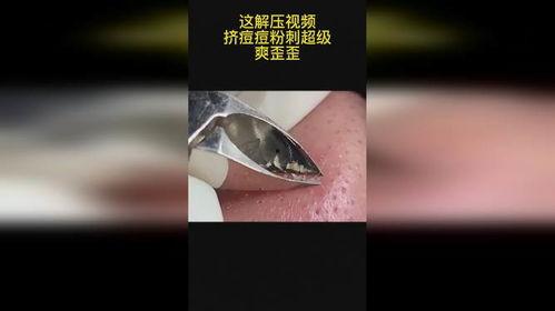 挤痘痘和挤黑头的视频,视频教学与注意事项