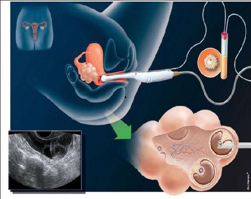 试管婴儿移植视频,科技助力生命延续